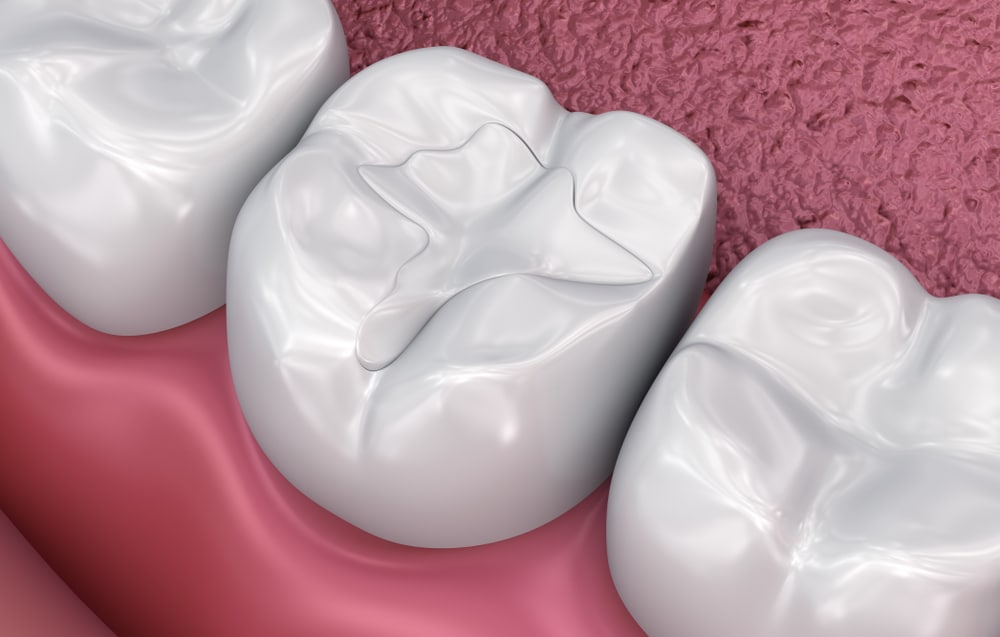 Dental Fillings in Cloverdale