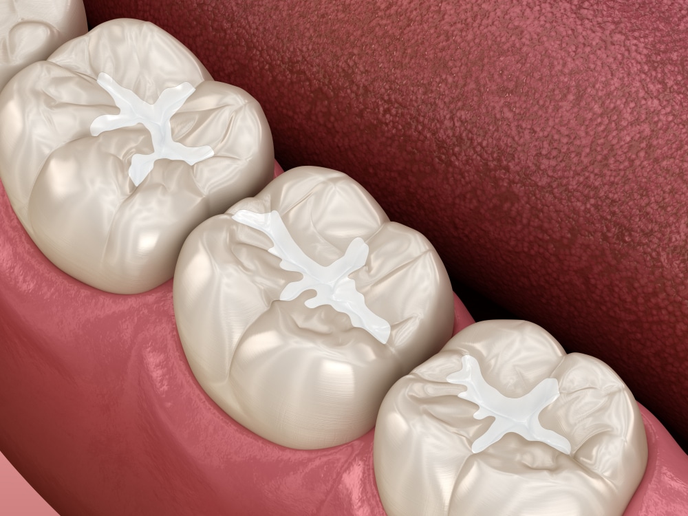 Dental Sealants in Cloverdale