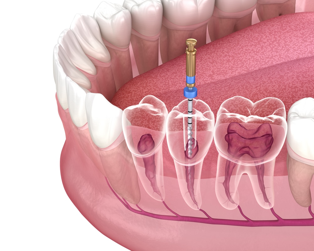 Root Canals in Cloverdale