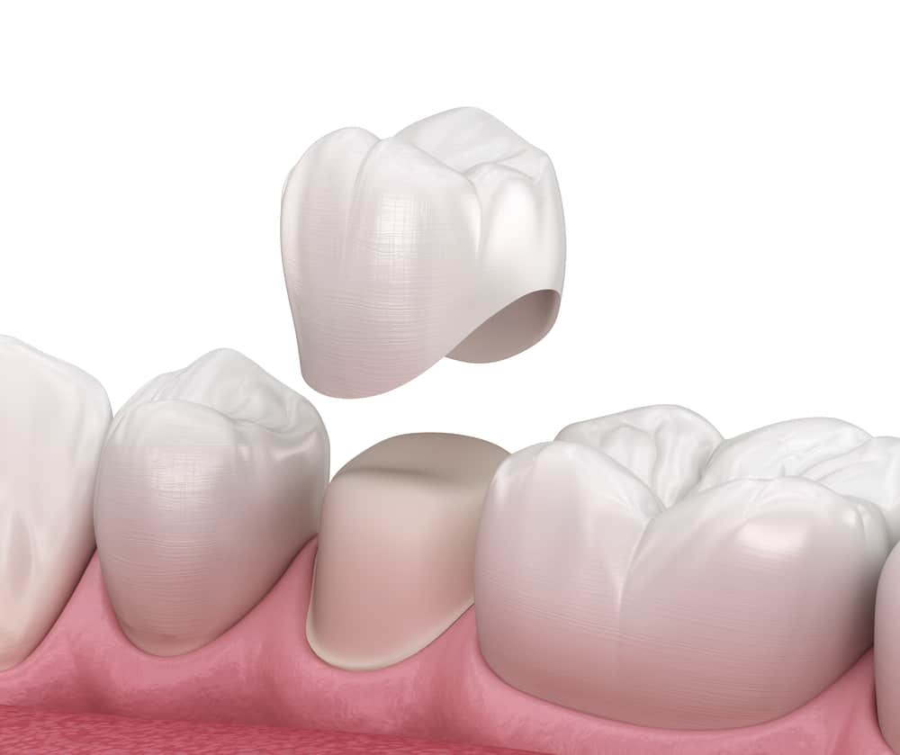 dental crowns in Cloverdale
