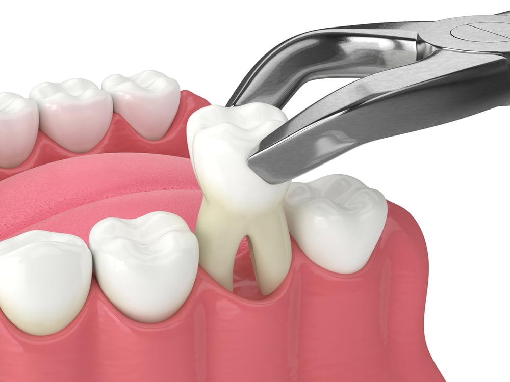 Tooth Extractions in cloverdale