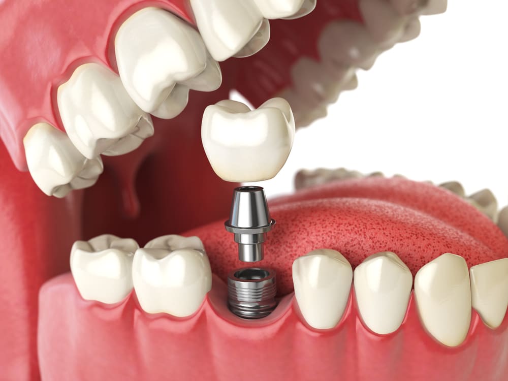 Dental Implants in Cloverdale