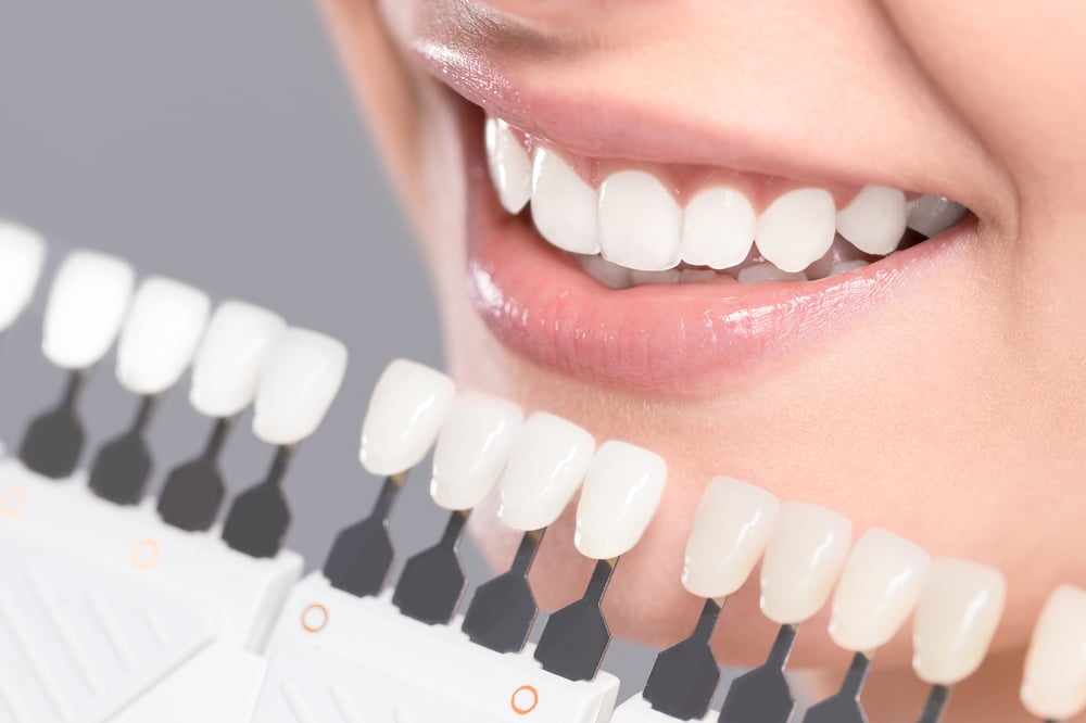 Teeth Whitening in Cloverdale
