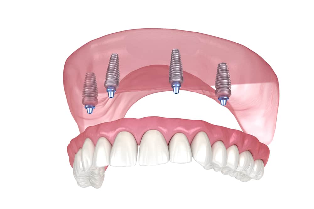 All on 4 Dental Implants in Cloverdale, Surrey, BC