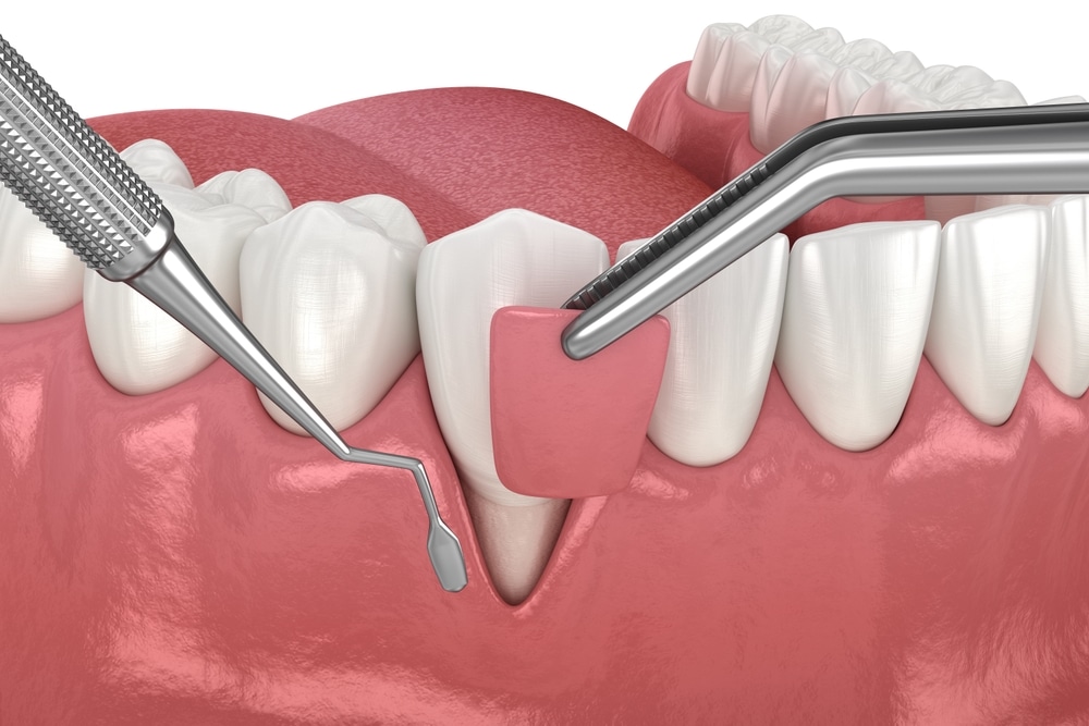 Gum Grafting in Cloverdale, BC, Surrey, BC